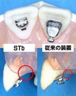 STbブラケットの特徴